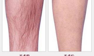 永久性脱毛多少钱 永久性脱毛多少钱
